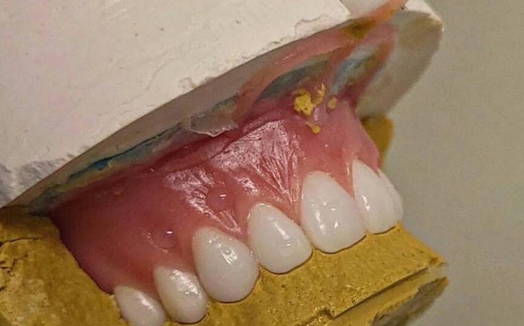 Hasil kerja JOE DENTAL — gigi palsu lepasan buatan tukang gigi Bandung (foto 5)