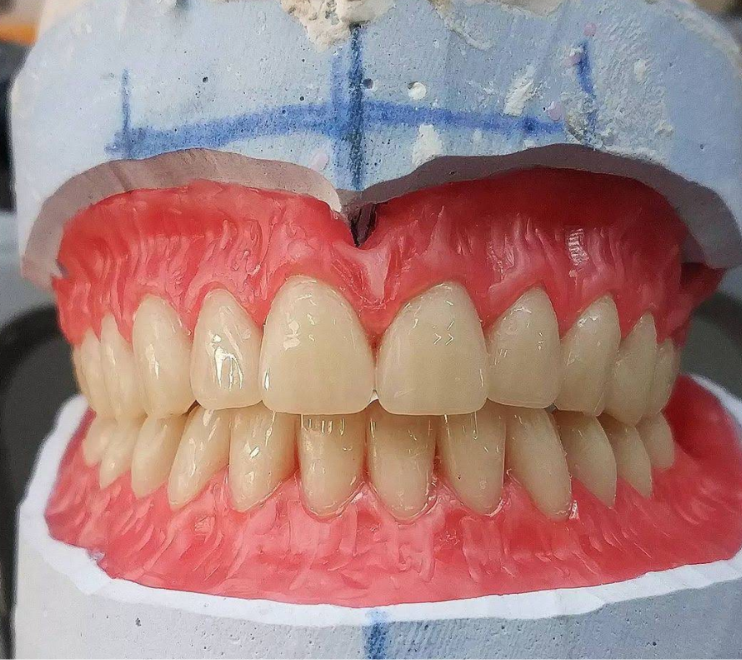 Hasil kerja JOE DENTAL — gigi palsu lepasan buatan tukang gigi Bandung (foto 6)
