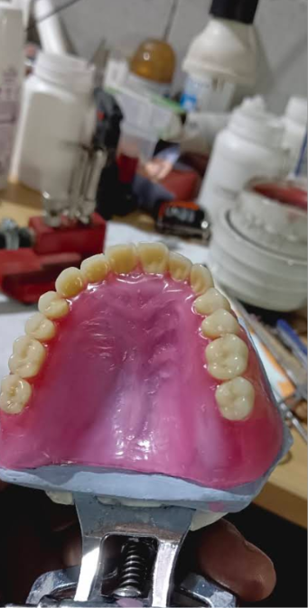 Hasil kerja JOE DENTAL — gigi palsu lepasan buatan tukang gigi Bandung (foto 9)
