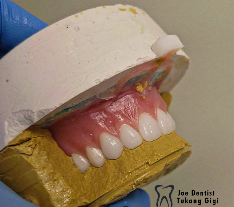 Hasil kerja JOE DENTAL — gigi palsu lepasan buatan tukang gigi Bandung (foto 3)