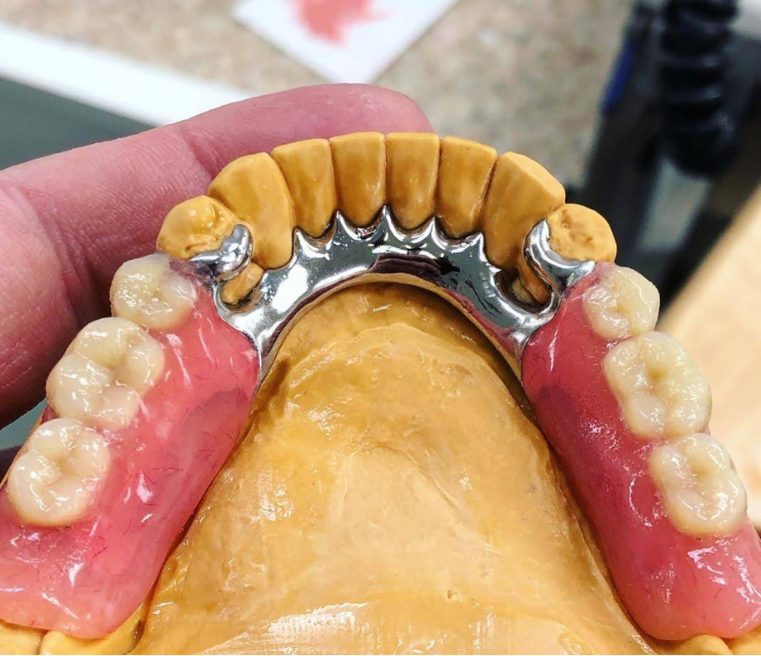 Hasil kerja JOE DENTAL — gigi palsu lepasan buatan tukang gigi Bandung (foto 4)